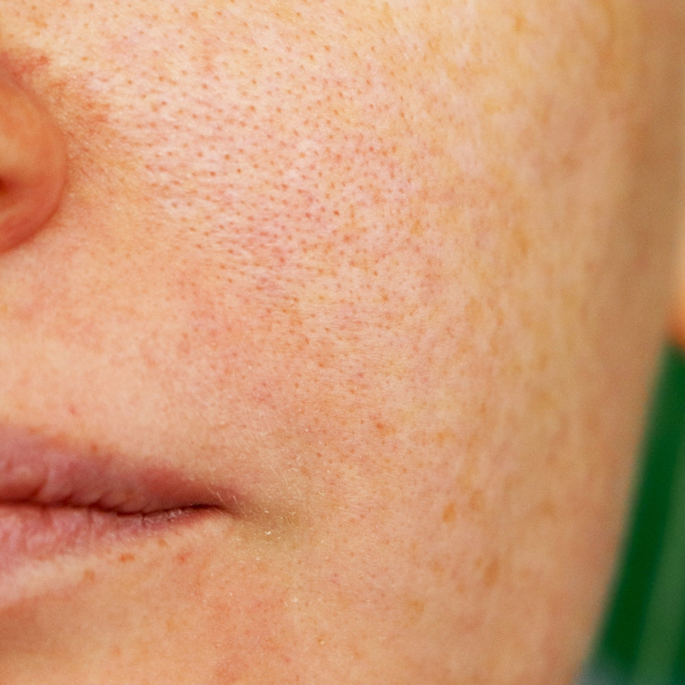 Pores dilatés